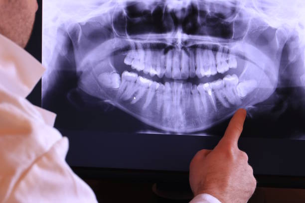 Best Emergency Tooth Extraction in Moorhead, MN